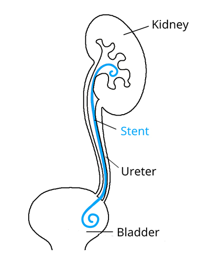Stent ureteral