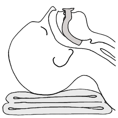 v&iacute;a a&eacute;rea orofar&iacute;ngea